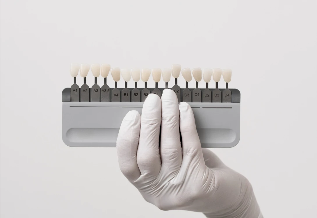 Corone in metalceramica - restauro dentale estetico da Windental