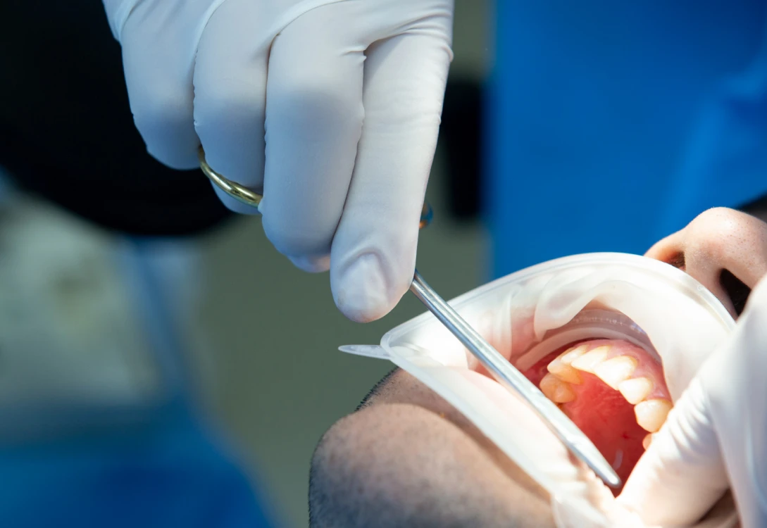 Estrazione dentale professionale - Windental Tirana Albania