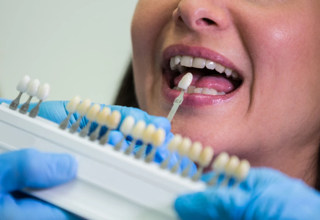 Impianti dentali standard in titanio - Windental clinica dentale Tirana