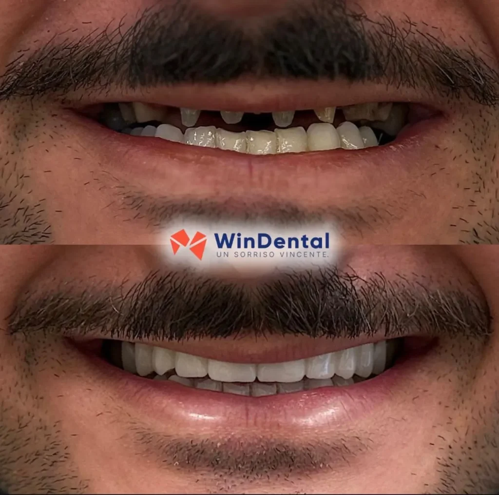 WinDental Prima e Dopo 03 - Tirana - WinDental Albania