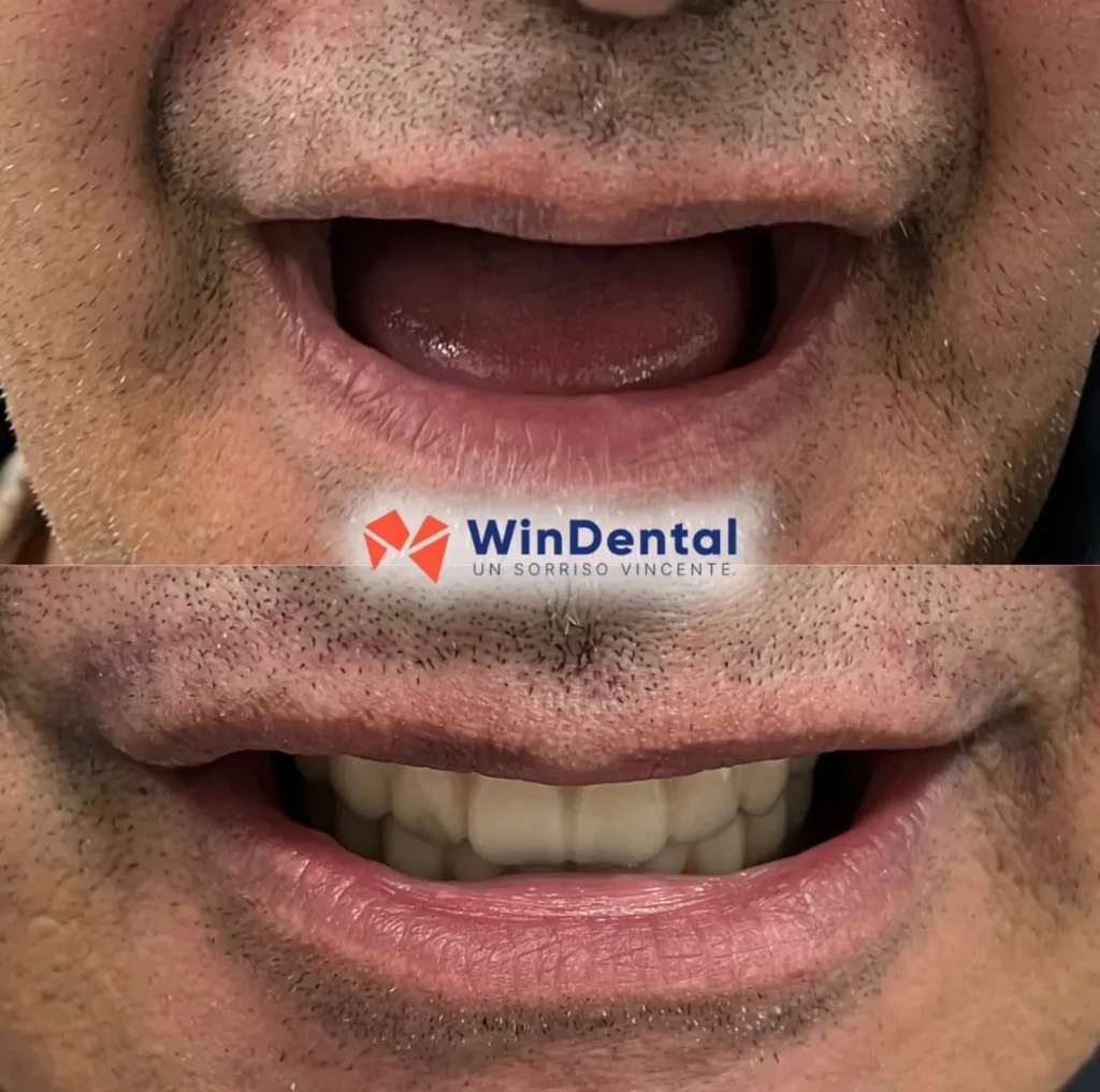 WinDental Prima e Dopo 07 - Tirana - WinDental Albania