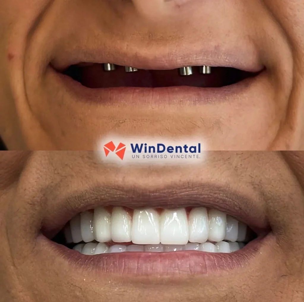 WinDental Prima e Dopo 09 - Tirana - WinDental Albania