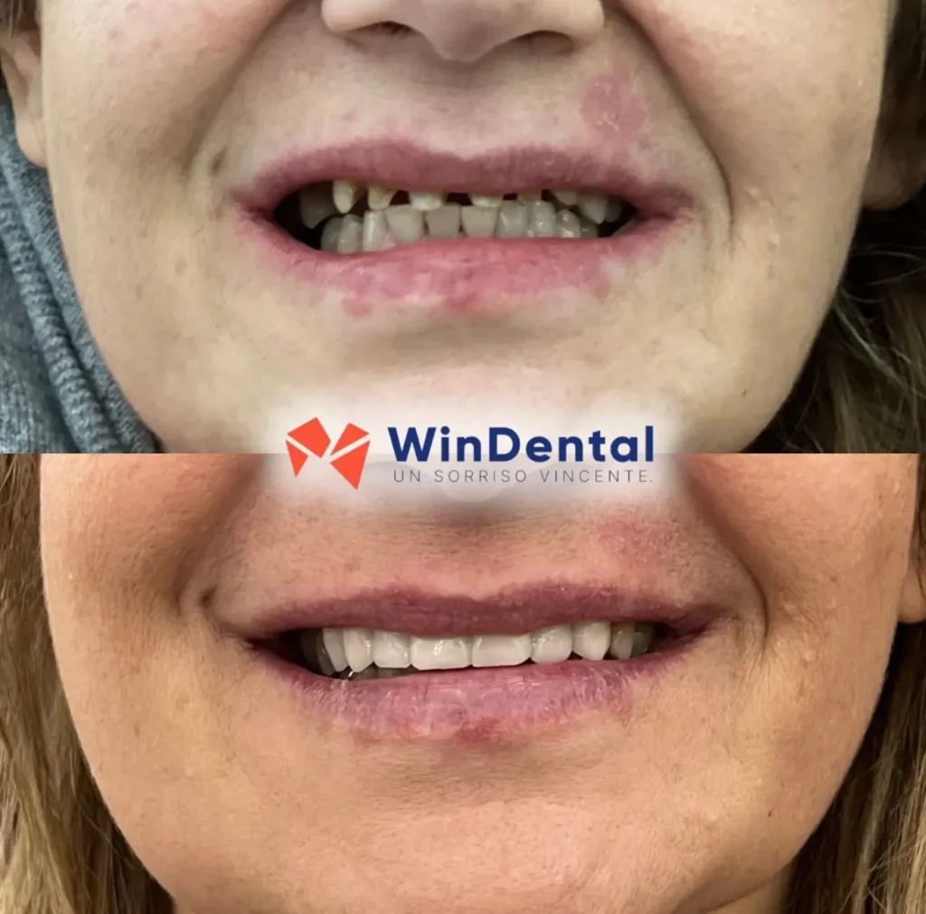 WinDental Prima e Dopo 10 - Tirana - WinDental Albania