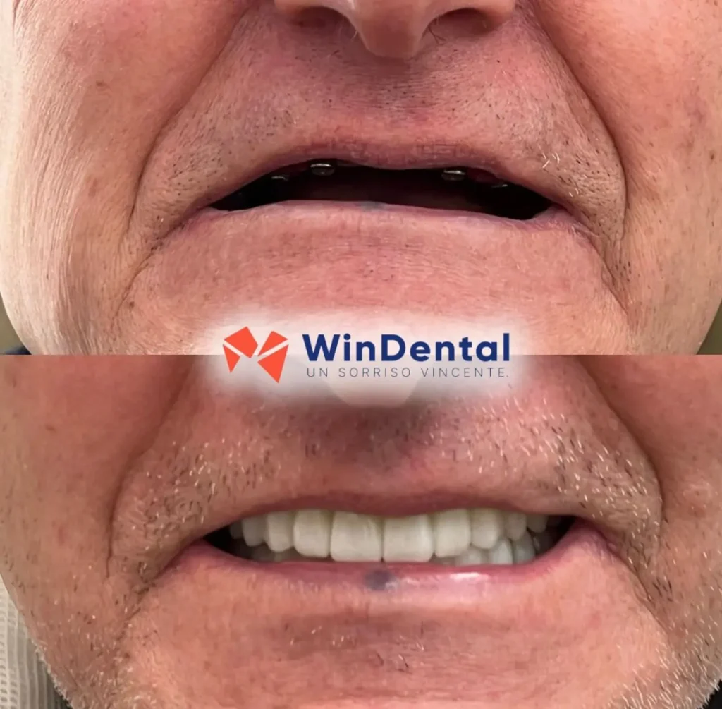 WinDental Prima e Dopo 11 - Tirana - WinDental Albania