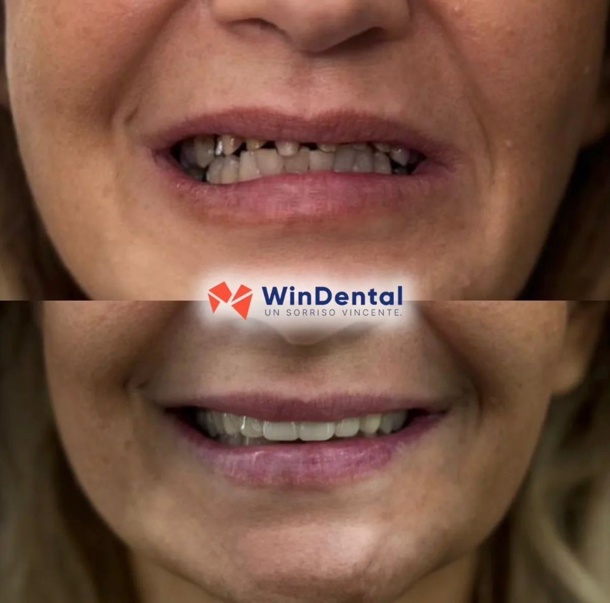 Implants + crowns · upper arch