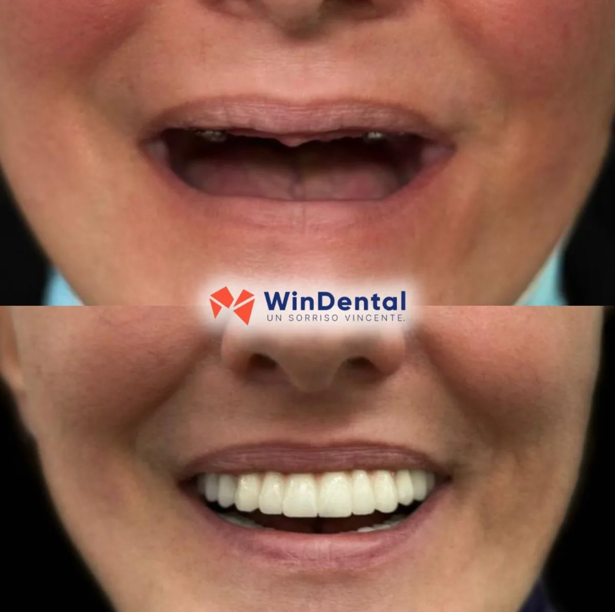 Implant + crowns · upper arch