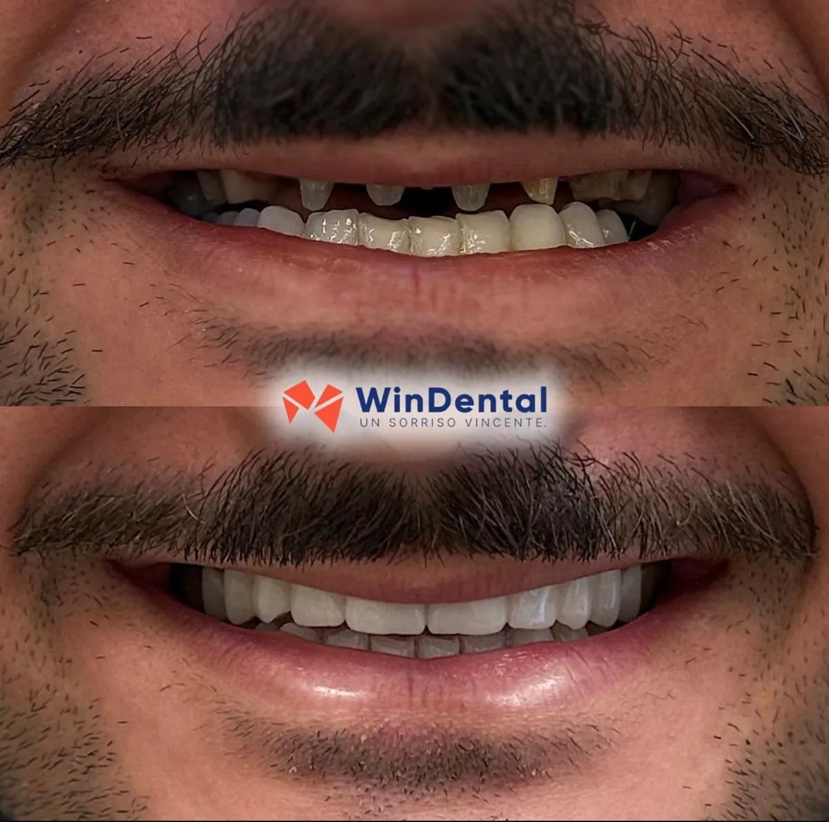 Smile makeover · veneers + crowns