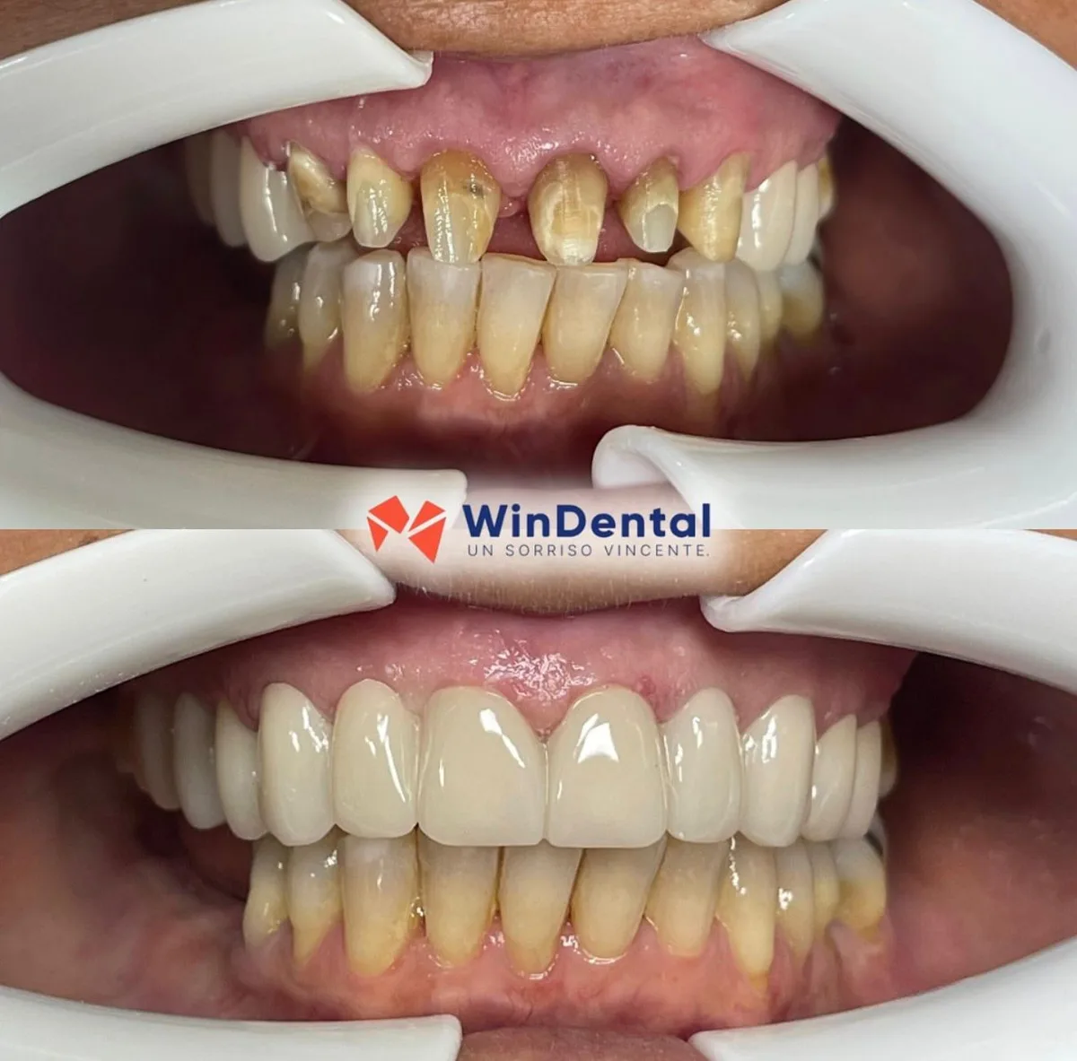 All-on-X upper arch · implant bridge