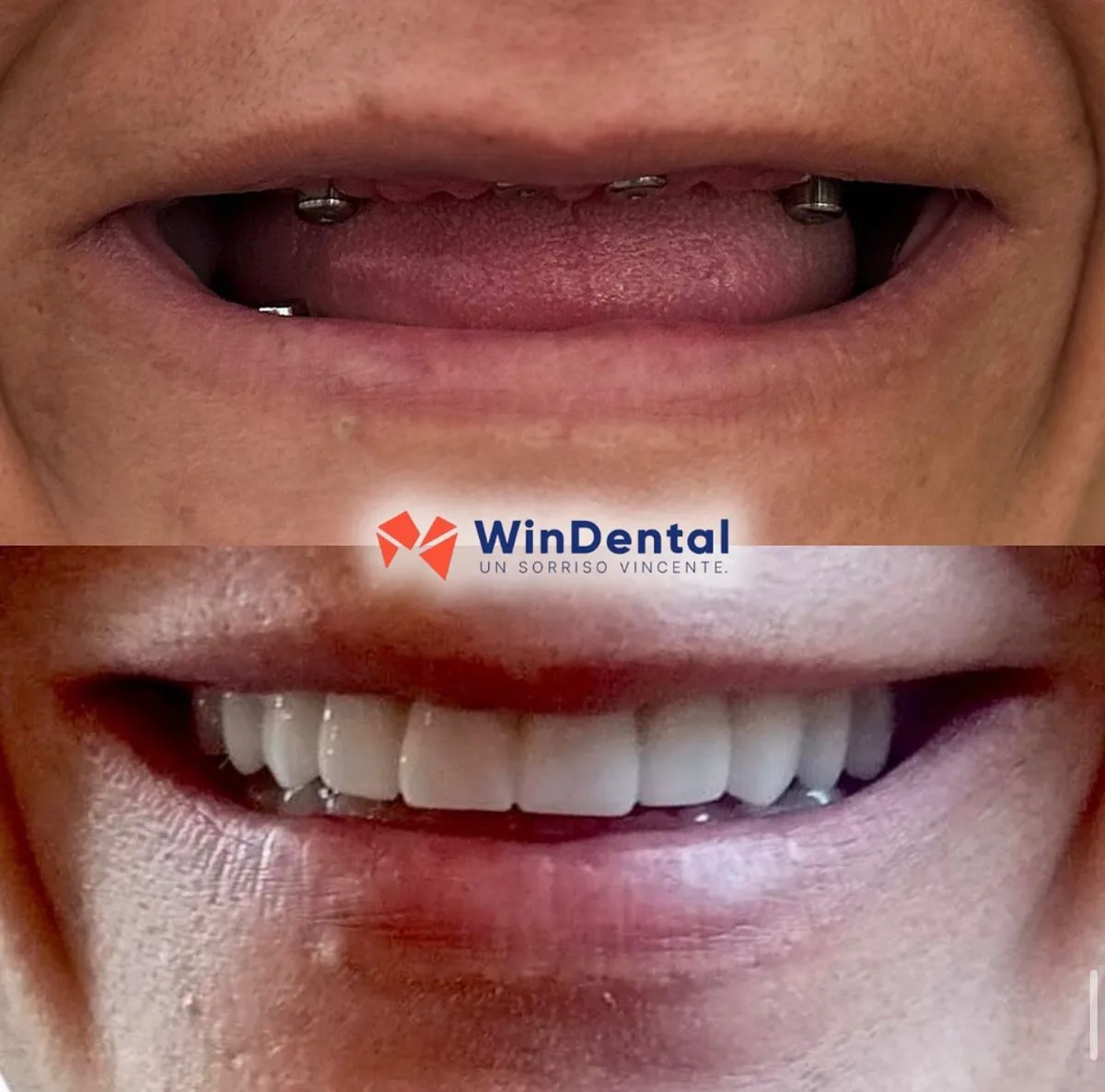 Yellowed teeth → zirconia veneers