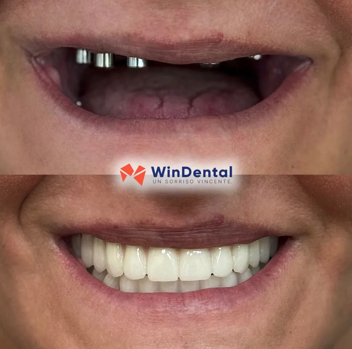 All-on-X lower arch · same day