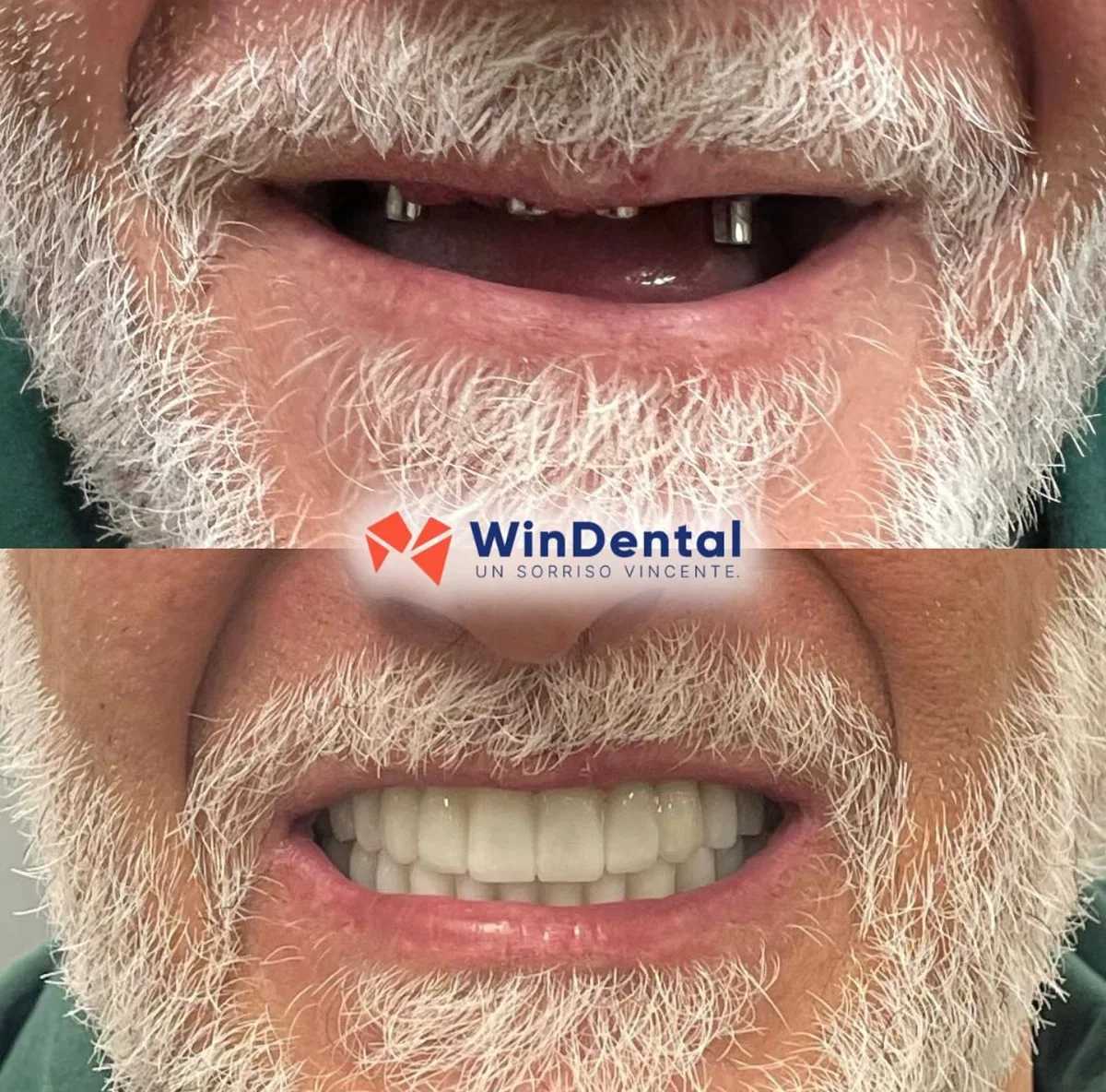 Full mouth restoration · severe decay → veneers